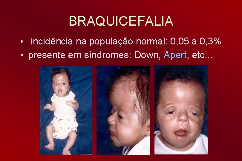 BRAQUICEFALIA • incidência na população normal: 0, 05 a 0, 3% • presente em