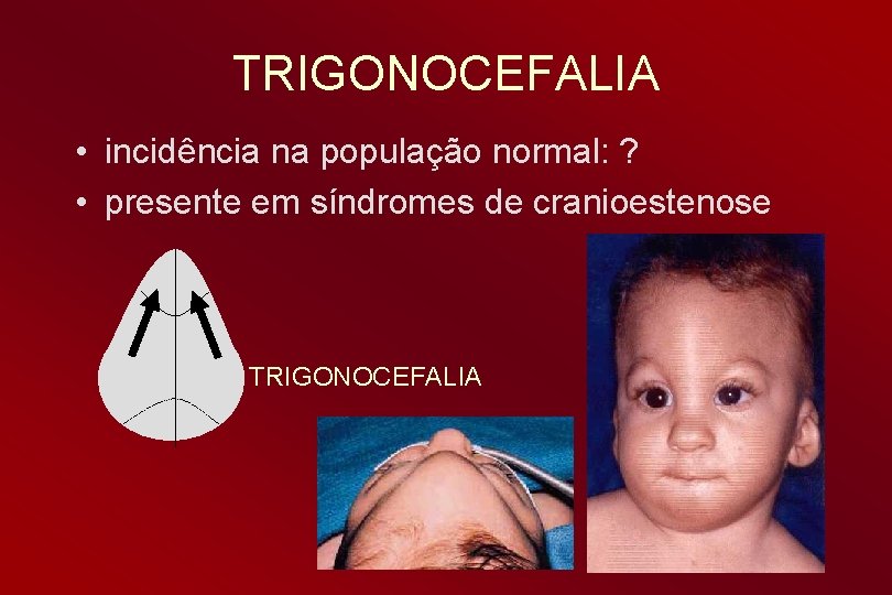 TRIGONOCEFALIA • incidência na população normal: ? • presente em síndromes de cranioestenose TRIGONOCEFALIA