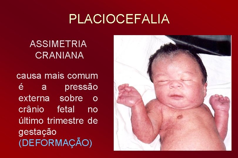 PLACIOCEFALIA ASSIMETRIA CRANIANA causa mais comum é a pressão externa sobre o crânio fetal