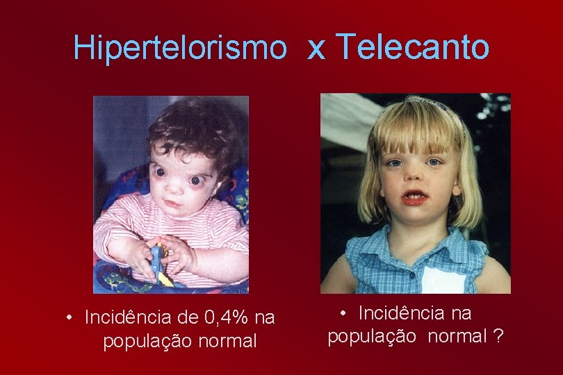 Hipertelorismo x Telecanto • Incidência de 0, 4% na população normal • Incidência na