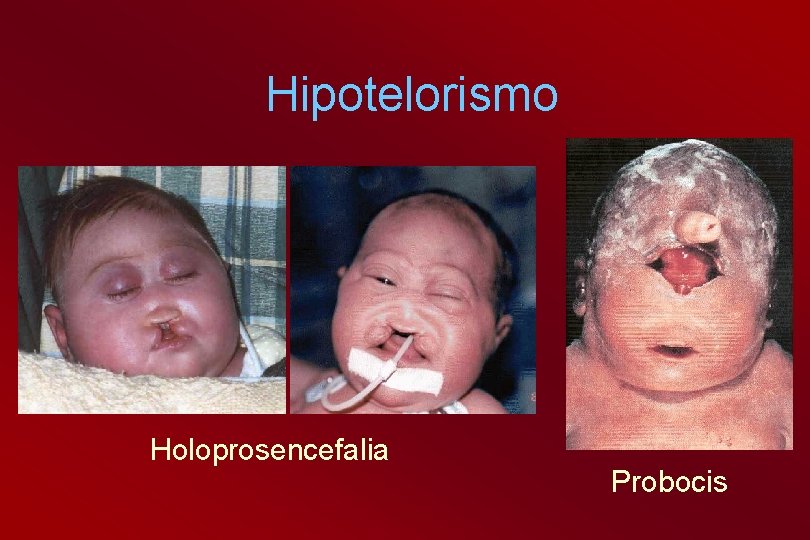 Hipotelorismo Holoprosencefalia Probocis 