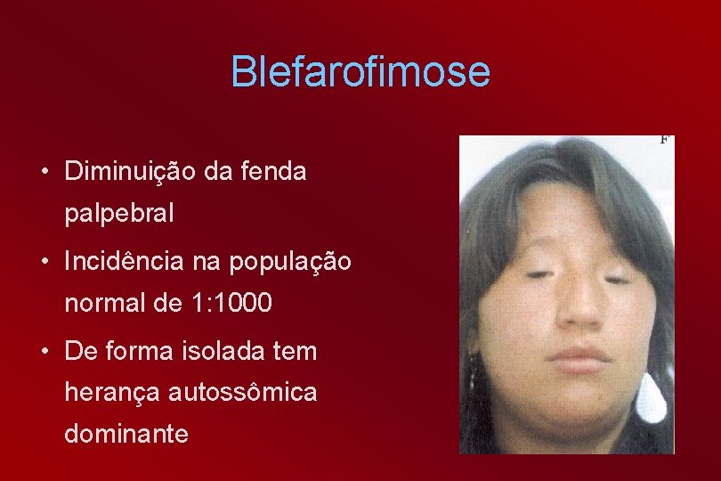 Blefarofimose • Diminuição da fenda palpebral • Incidência na população normal de 1: 1000