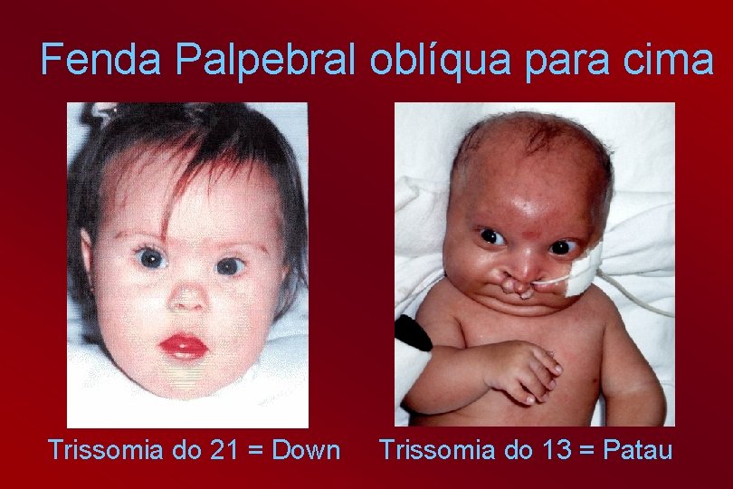 Fenda Palpebral oblíqua para cima Trissomia do 21 = Down Trissomia do 13 =