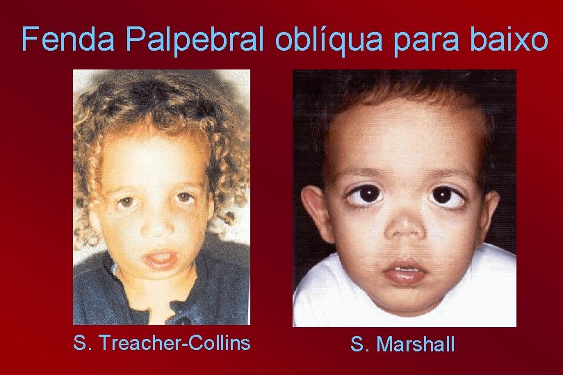 Fenda Palpebral oblíqua para baixo S. Treacher-Collins S. Marshall 