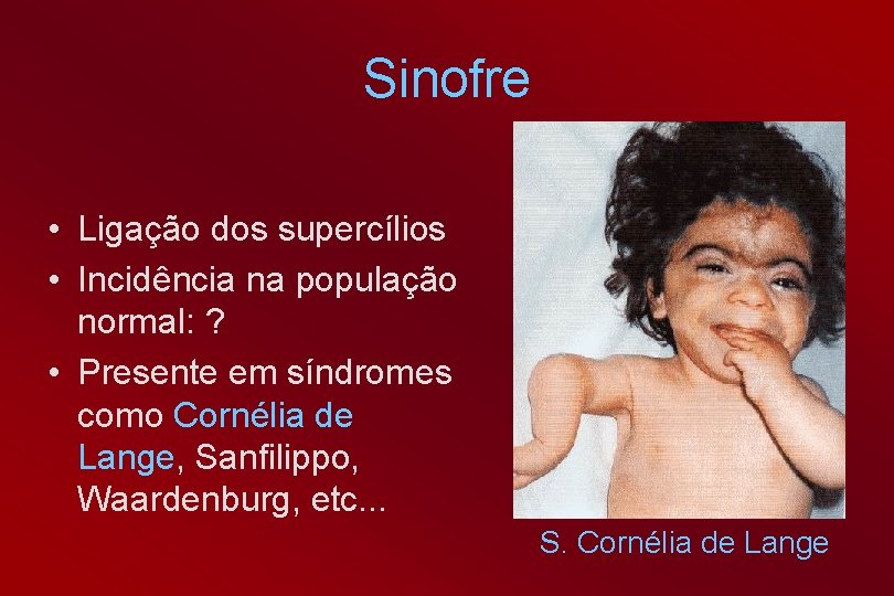 Sinofre • Ligação dos supercílios • Incidência na população normal: ? • Presente em