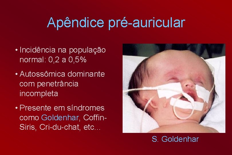 Apêndice pré-auricular • Incidência na população normal: 0, 2 a 0, 5% • Autossômica