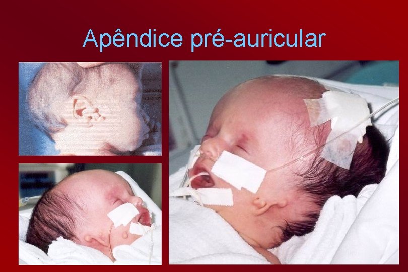 Apêndice pré-auricular 