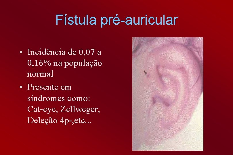 Fístula pré-auricular • Incidência de 0, 07 a 0, 16% na população normal •