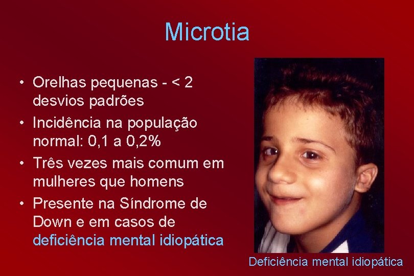 Microtia • Orelhas pequenas - < 2 desvios padrões • Incidência na população normal: