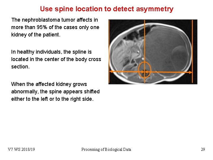 Use spine location to detect asymmetry The nephroblastoma tumor affects in more than 95%