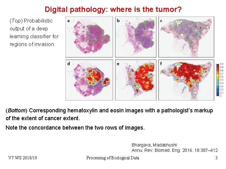 Digital pathology: where is the tumor? (Top) Probabilistic output of a deep learning classifier