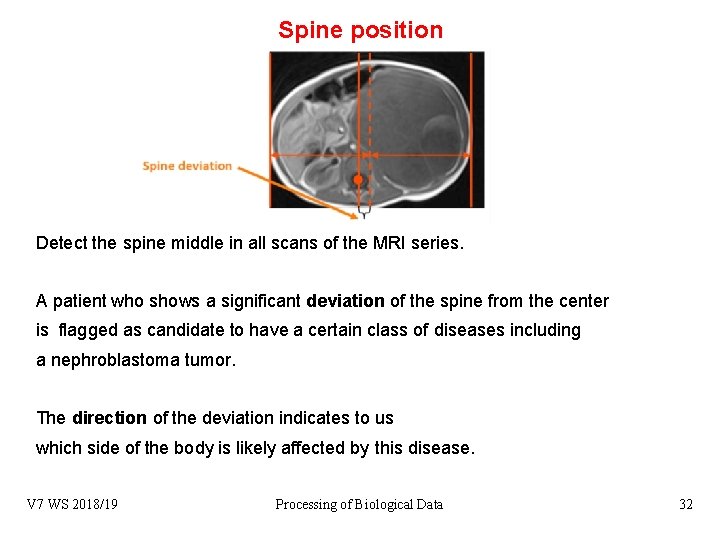 Spine position Detect the spine middle in all scans of the MRI series. A