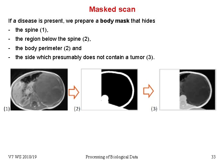 Masked scan If a disease is present, we prepare a body mask that hides