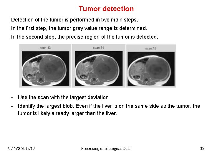 Tumor detection Detection of the tumor is performed in two main steps. In the