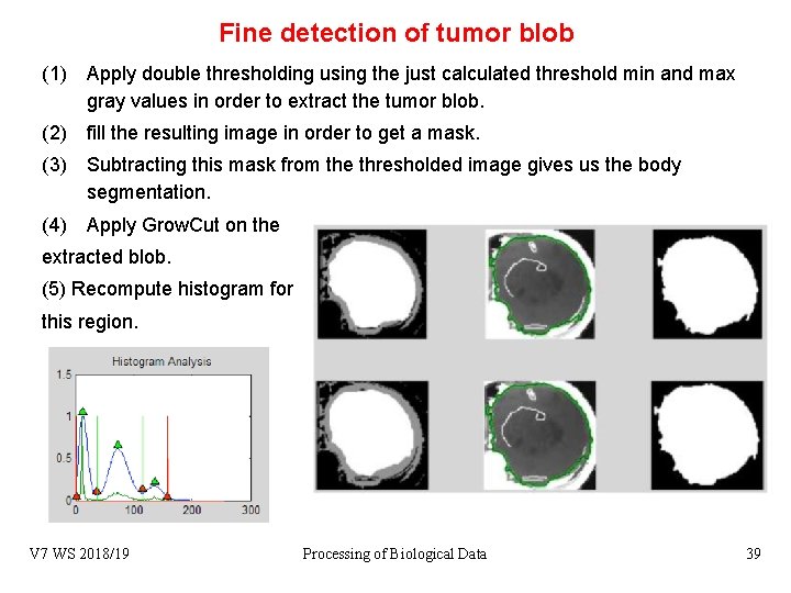 Fine detection of tumor blob (1) Apply double thresholding using the just calculated threshold