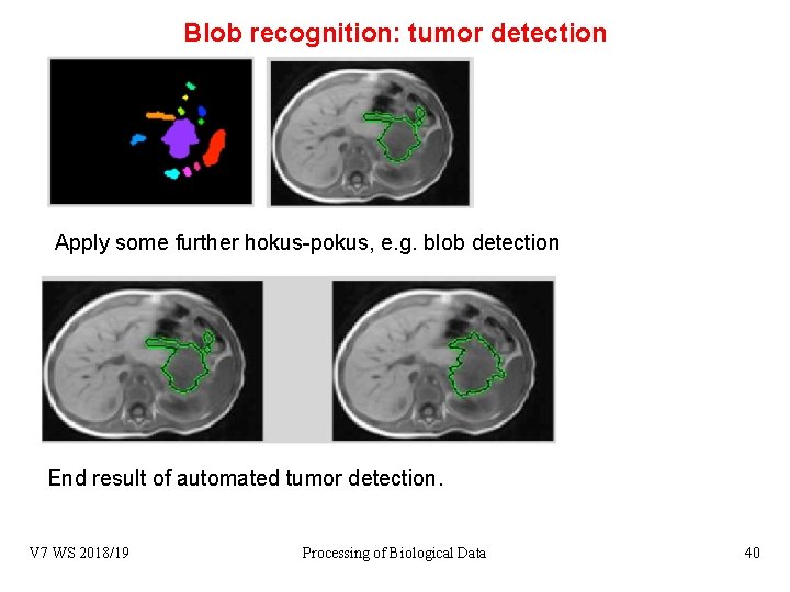 Blob recognition: tumor detection Apply some further hokus-pokus, e. g. blob detection End result