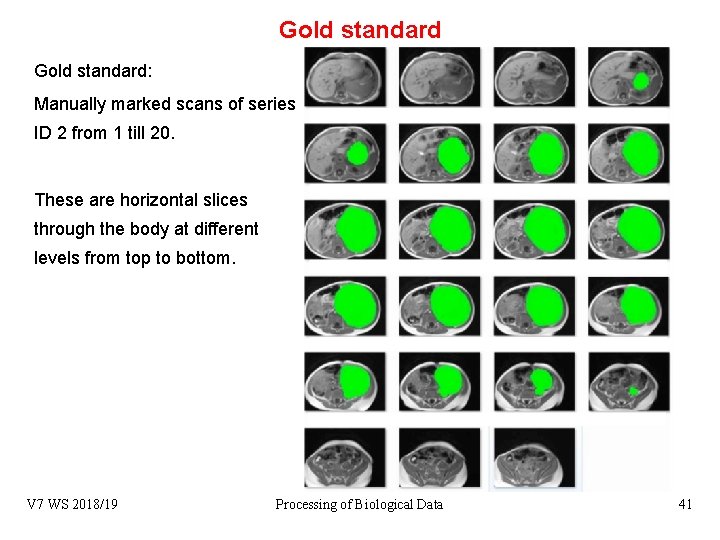 Gold standard: Manually marked scans of series ID 2 from 1 till 20. These