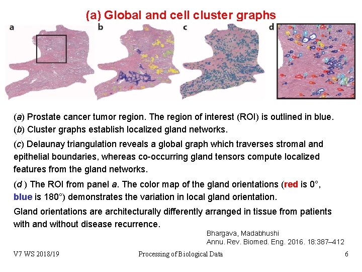 (a) Global and cell cluster graphs (a) Prostate cancer tumor region. The region of