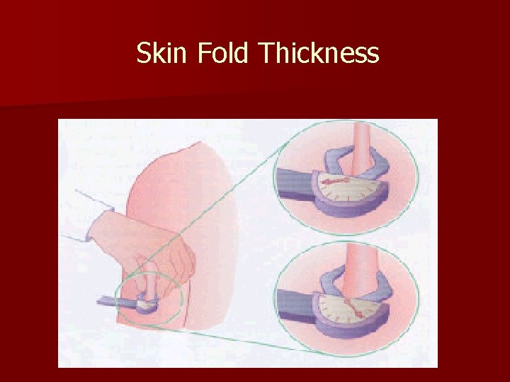 Skin Fold Thickness 