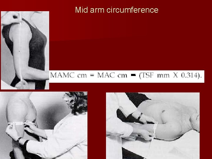 Mid arm circumference 