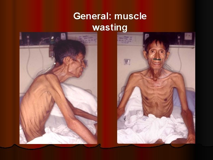 General: muscle wasting 