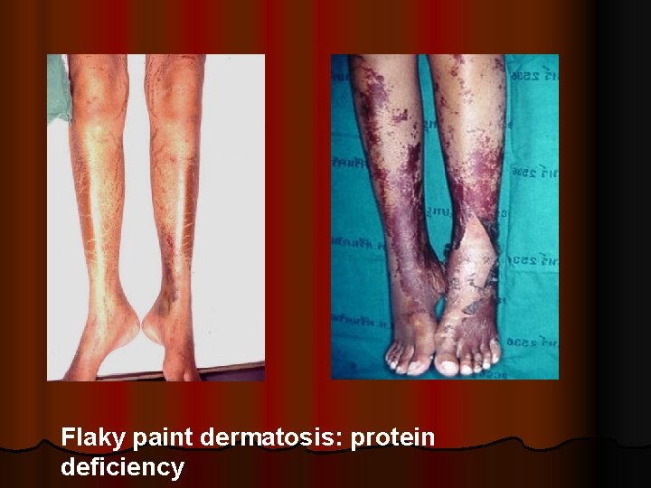 Flaky paint dermatosis: protein deficiency 