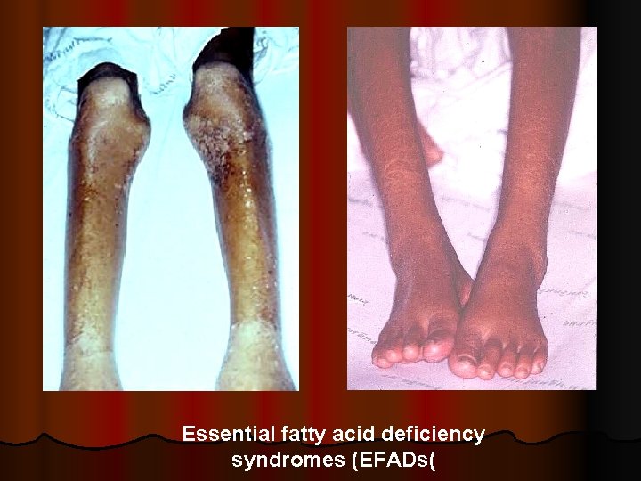 Essential fatty acid deficiency syndromes (EFADs( 