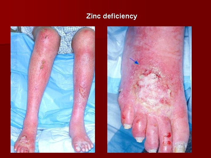 Zinc deficiency 