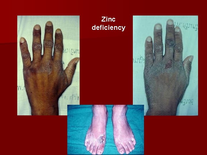 Zinc deficiency 