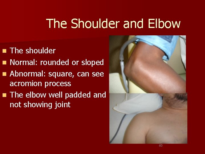 The Shoulder and Elbow n n The shoulder Normal: rounded or sloped Abnormal: square,