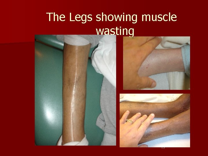 The Legs showing muscle wasting 63 