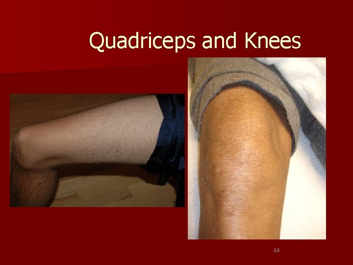 Quadriceps and Knees 64 