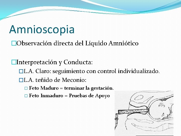 Amnioscopia �Observación directa del Líquido Amniótico �Interpretación y Conducta: �L. A. Claro: seguimiento control