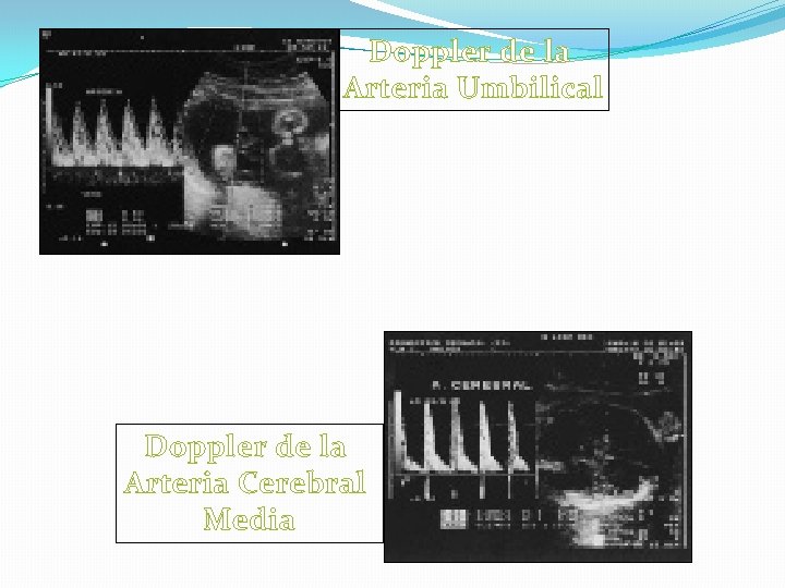 Doppler de la Arteria Umbilical Doppler de la Arteria Cerebral Media 