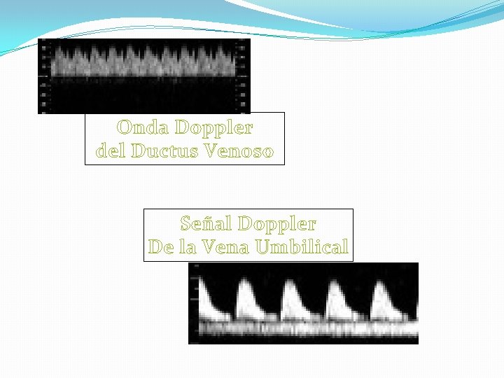 Onda Doppler del Ductus Venoso Señal Doppler De la Vena Umbilical 