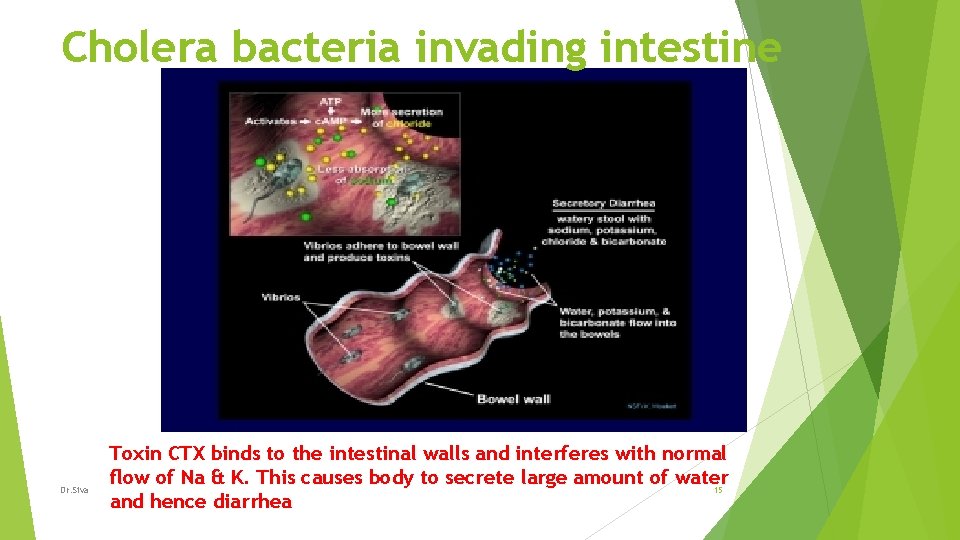 Cholera bacteria invading intestine Dr. Siva Toxin CTX binds to the intestinal walls and