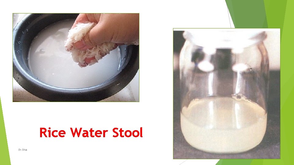 Rice Water Stool Dr. Siva 16 