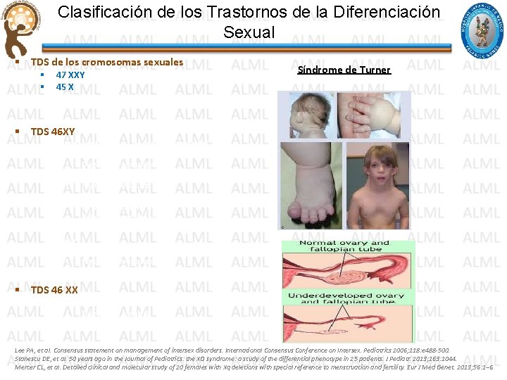 Clasificación de los Trastornos de la Diferenciación Sexual § TDS de los cromosomas sexuales