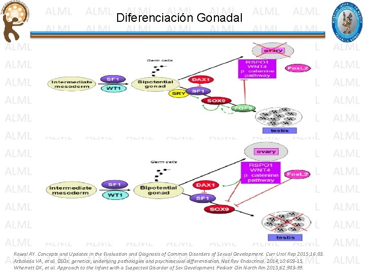 Diferenciación Gonadal Rawal AY. Concepts and Updates in the Evaluation and Diagnosis of Common