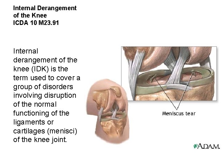 Internal Derangement of the Knee ICDA 10 M 23. 91 Internal derangement of the