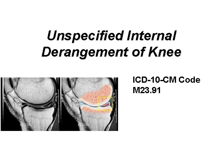 Unspecified Internal Derangement of Knee ICD-10 -CM Code M 23. 91 