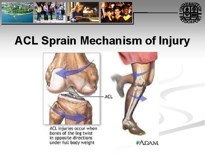 ACL Sprain Mechanism of Injury 