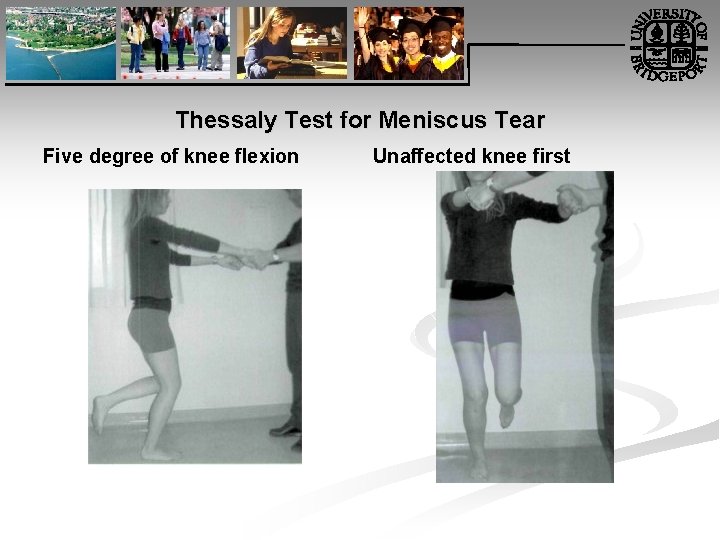 Thessaly Test for Meniscus Tear Five degree of knee flexion Unaffected knee first 