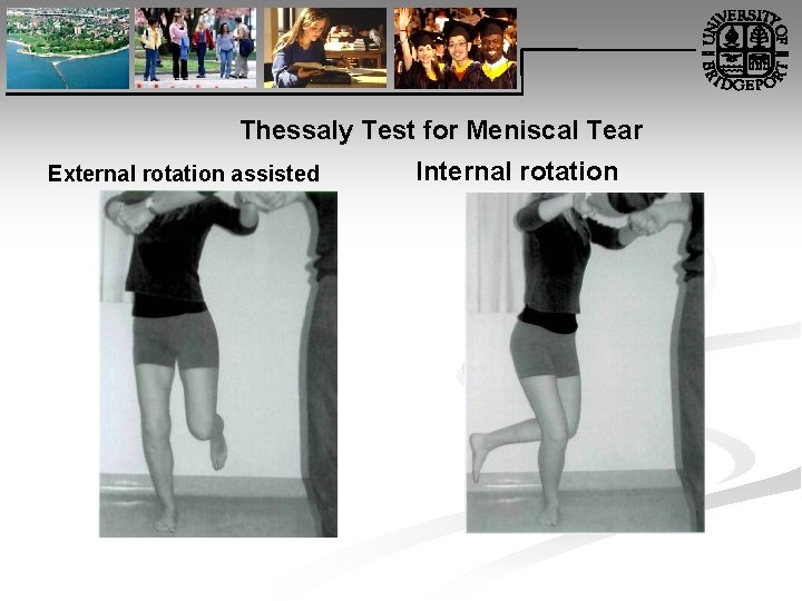 Thessaly Test for Meniscal Tear External rotation assisted Internal rotation 