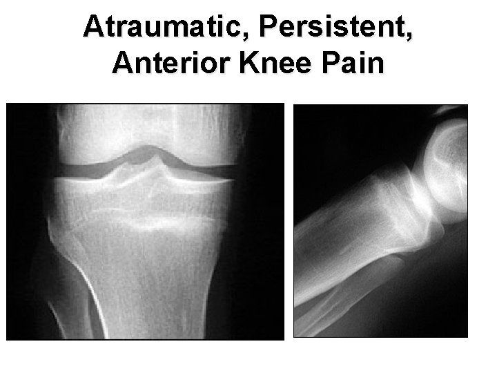 Atraumatic, Persistent, Anterior Knee Pain 