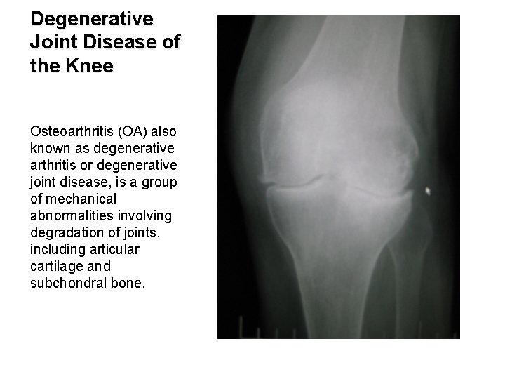 Degenerative Joint Disease of the Knee Osteoarthritis (OA) also known as degenerative arthritis or