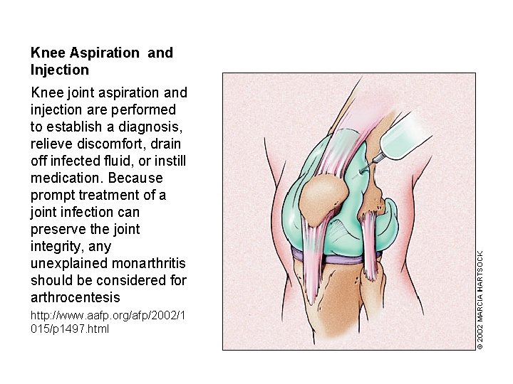 Knee Aspiration and Injection Knee joint aspiration and injection are performed to establish a