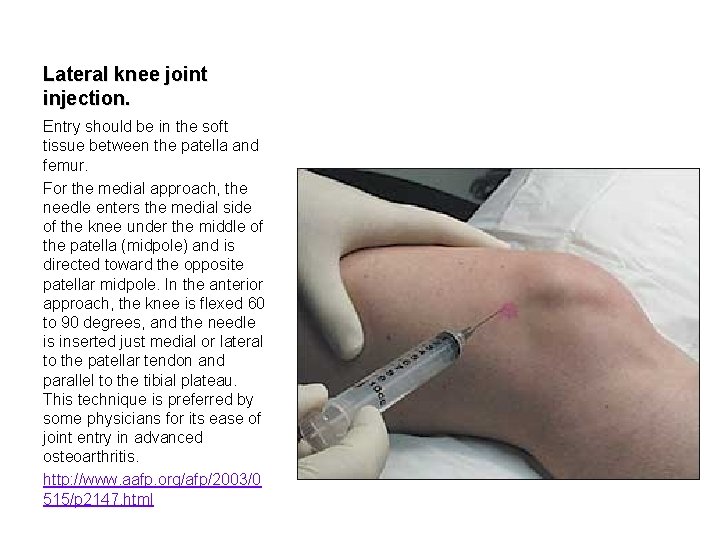 Lateral knee joint injection. Entry should be in the soft tissue between the patella
