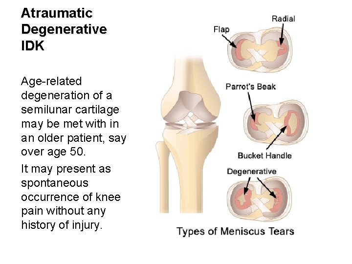 Atraumatic Degenerative IDK Age related degeneration of a semilunar cartilage may be met with