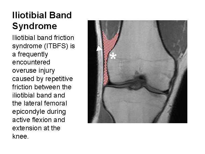 Iliotibial Band Syndrome Iliotibial band friction syndrome (ITBFS) is a frequently encountered overuse injury